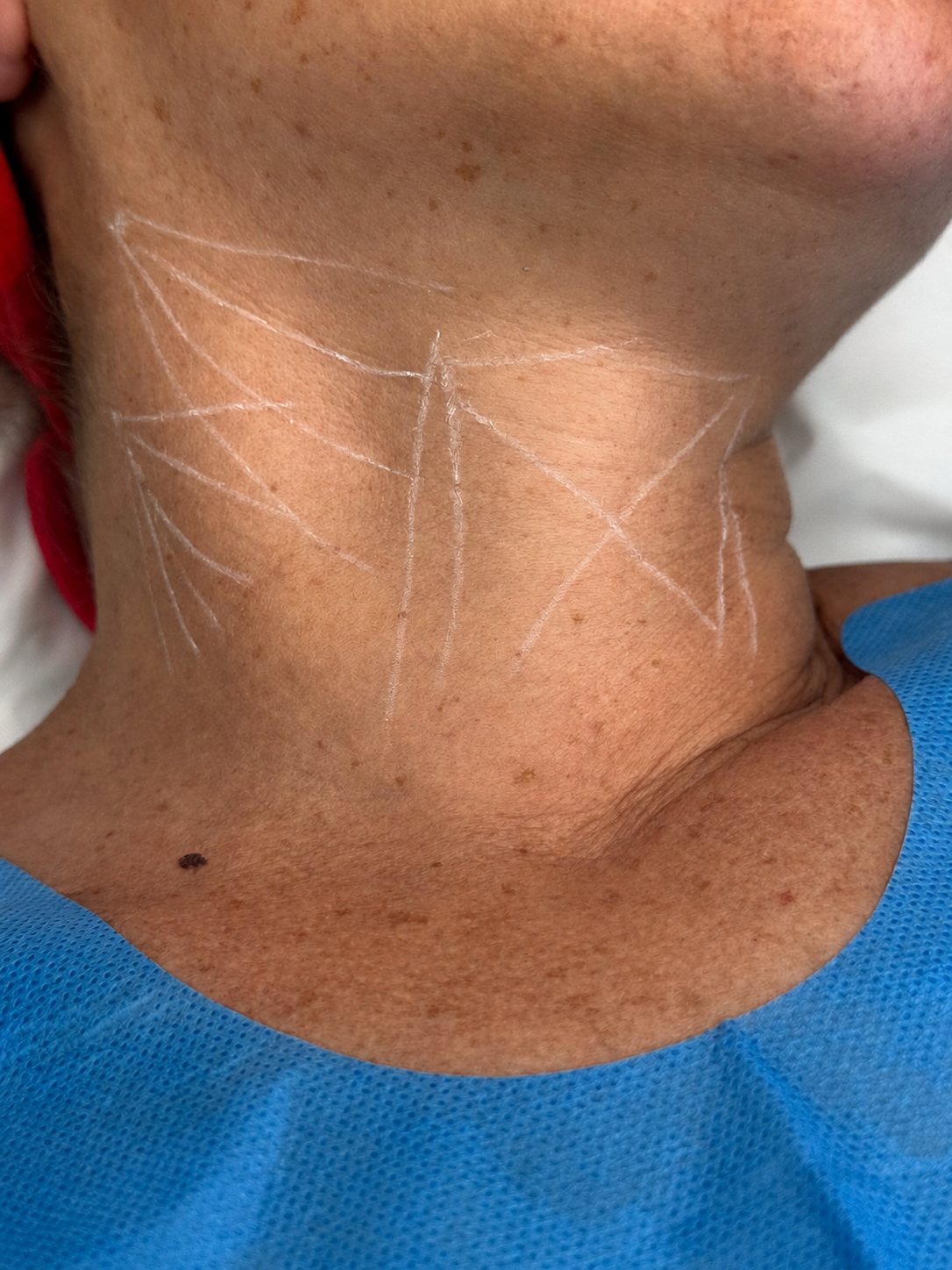 Tracé des zones à traiter sur le cou avant une séance d'Endolift®