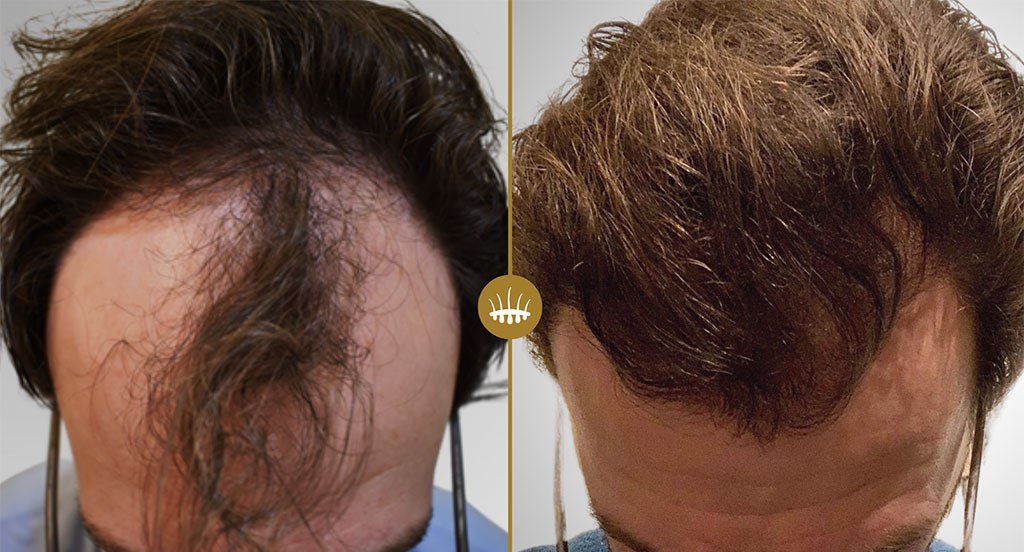 Avant et après une greffe de cheveux HST de 1 650 greffons sur une calvitie frontale, chez un homme